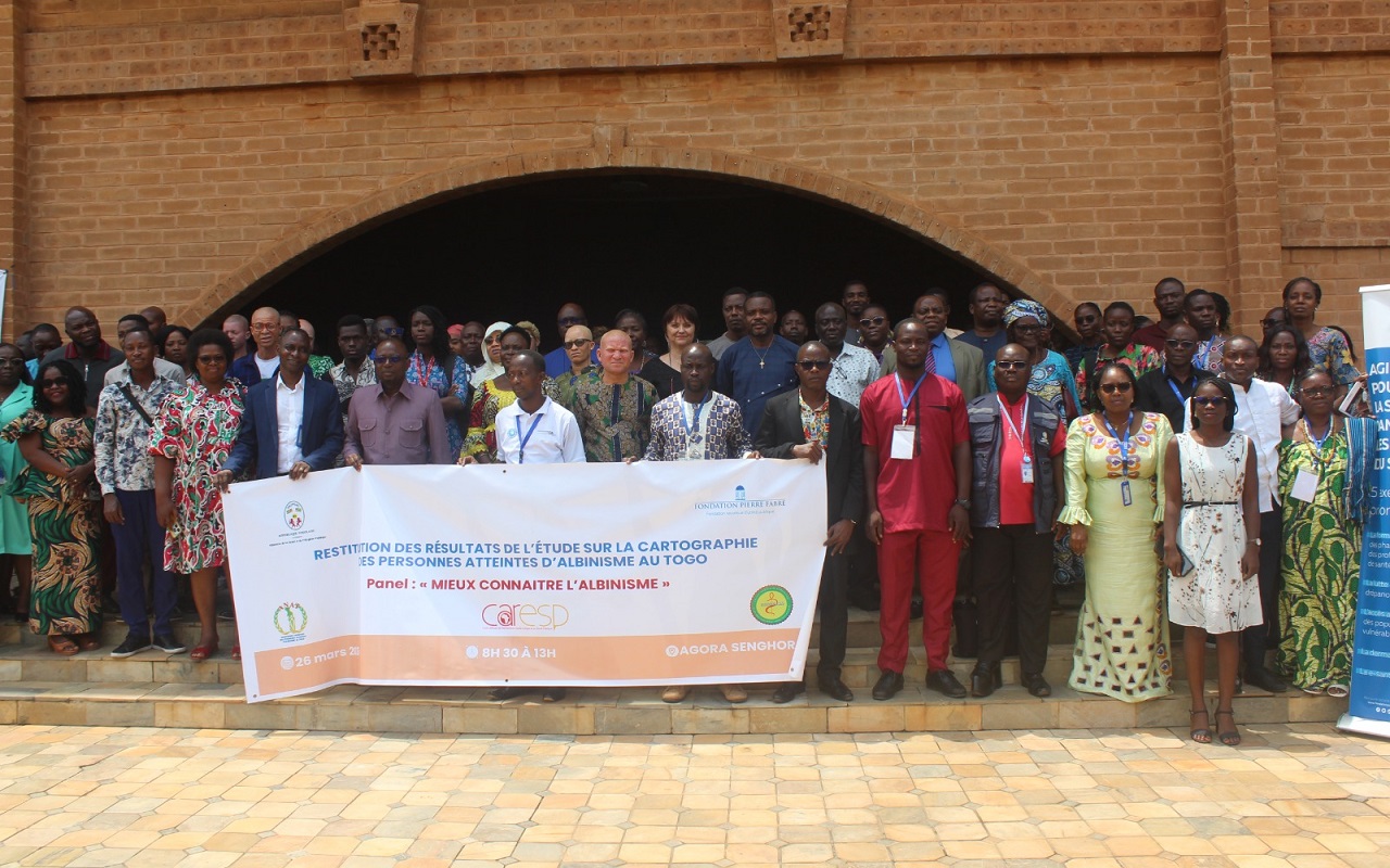 Togo : 18,79 Personnes Atteintes d'Albinisme pour 100 000 habitants, une étude révèle des défis sanitaires majeurs -